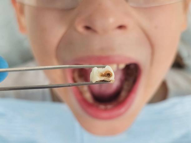 Best Emergency Dentist for Knocked-Out Tooth in Truckee, CA